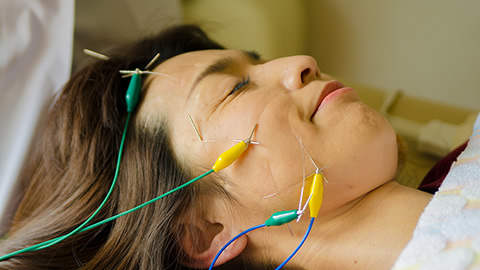 美容鍼(電気あり)